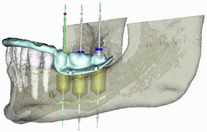 Planificación Nobel Clinician Clínicas Brizuela Díaz