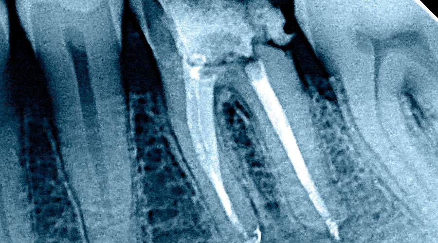 Endodoncia Clínicas Brizuela Díaz